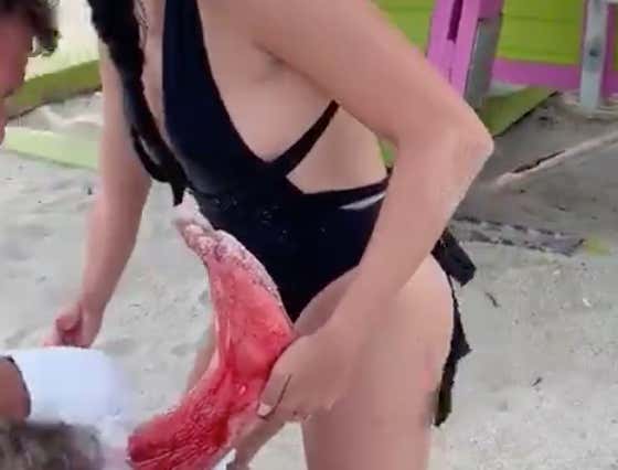 Florida Man Taken To The Hospital After Bloody Shark Attack Off Miami Beach