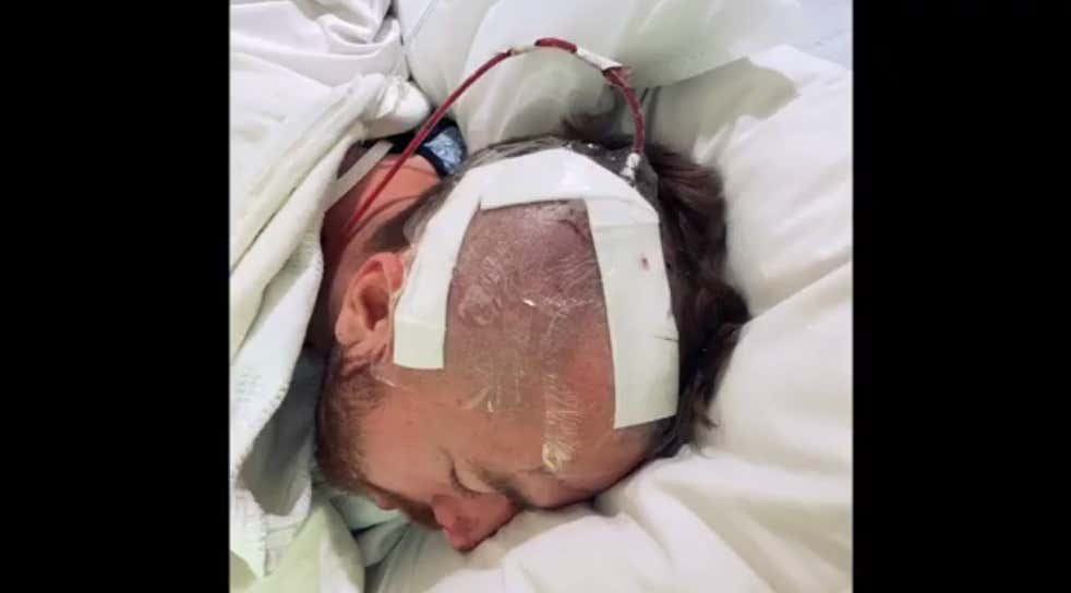 Rays Minor League Pitcher Tyler Zombro Was Hit In The Head Back In June And Had To Have Emergency Brain Surgery. In A Week And A Half He'll Report To Rays Camp And Pitch Again.