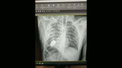 There are Tough Days. Then There are Days When it's Your Job to Surgically Remove an Unexploded Grenade from a Ukranian Soldier's Chest.