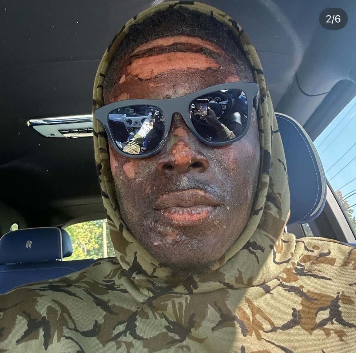 Browns TE David Njoku Might Be The Toughest Man Alive For Playing An Entire NFL Game With Severe Burns On His Face