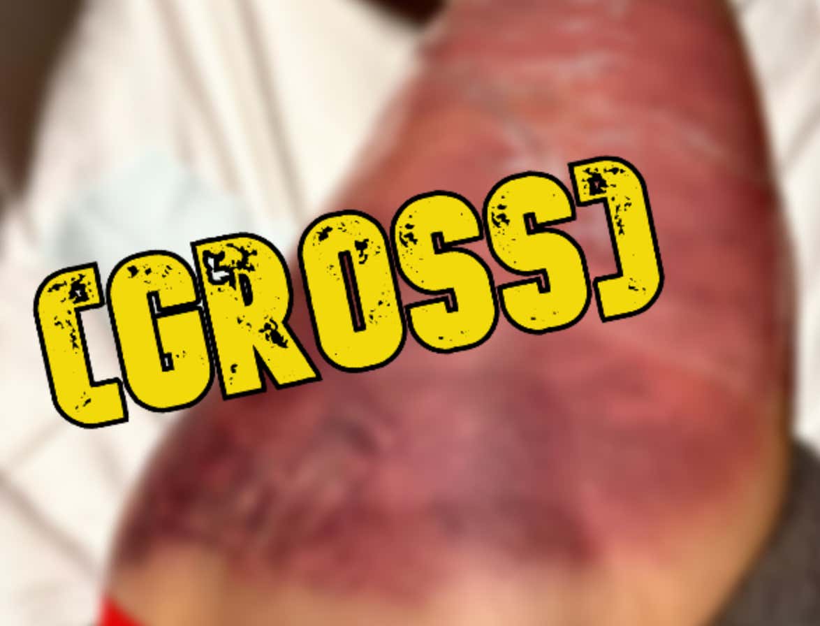 This Is The Worst Battered Up Leg I've Ever Seen After A Fight