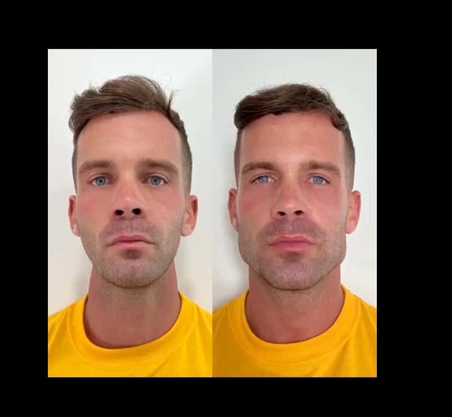 Men Are Getting Jaw Filler To Accomplish The Latest Trend Of "Looksmaxxing"