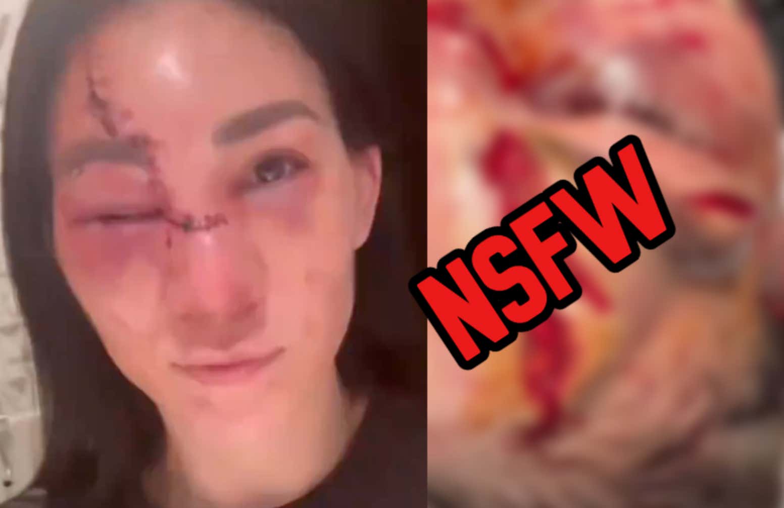 This Might Be The Most Grotesque, Disgusting Cut In UFC History