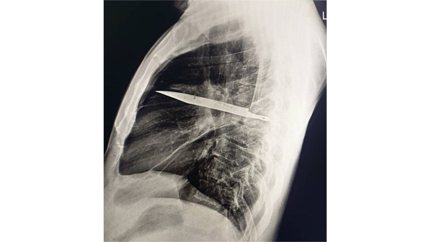 The Human Body Is Amazing: Man Unknowingly Had A Knife Stuck Inside His Chest For 8 Years
