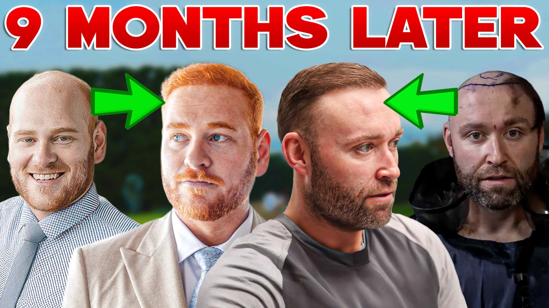 Reuniting with Everyone I Helped Get Hair Transplants + How To Apply for #BALDSTOOL Season 2