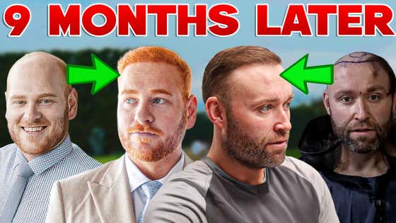 Reuniting with Everyone I Helped Get Hair Transplants + How To Apply for #BALDSTOOL Season 2