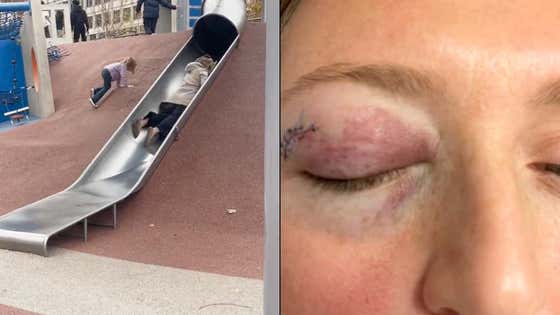 The Boston Cop Slide Claims Another Victim - This Woman Received A Black Eye That Required 8 Stitches