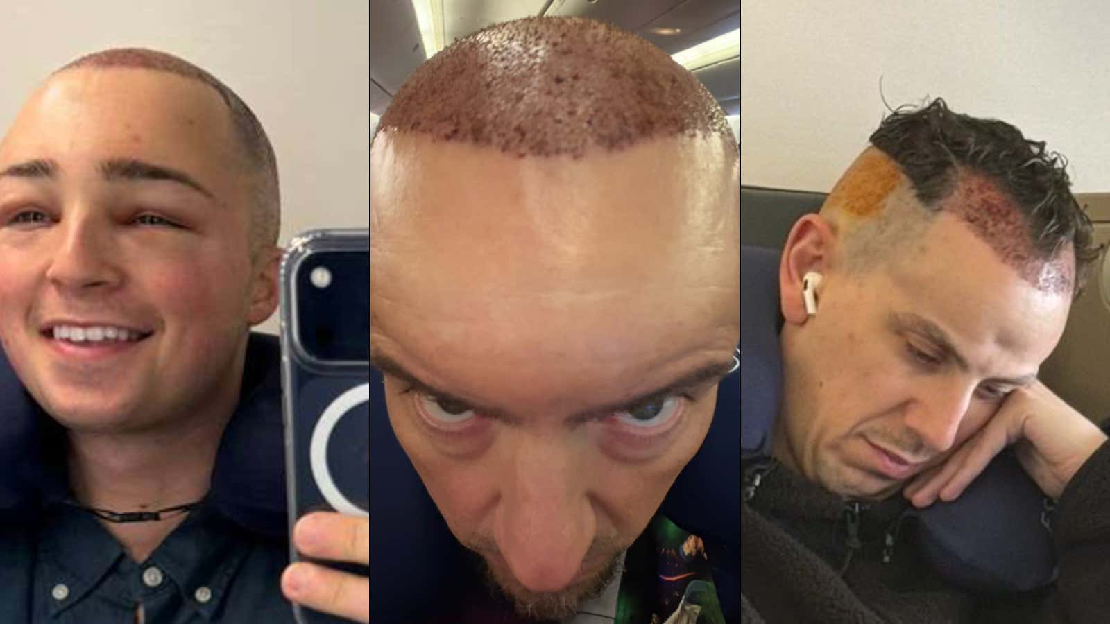 Ranking The Worst Looking Baldstool People Post-OP
