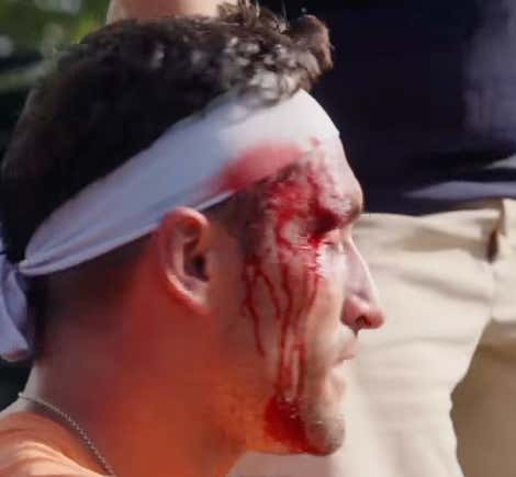 Pickleball Players Are Warriors. Take Paddle Straight To The Face, And Still Finish Out The Match While Bleeding All Over The Place