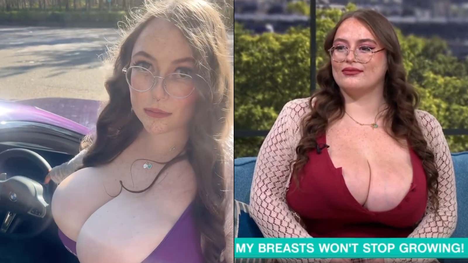 ALERT: This Women's Size 30U Breasts Will NOT Stop Growing And Now Weigh Nearly 60 lbs