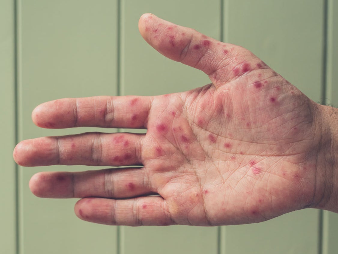 What It's Like To Be An Adult With Hand, Foot And Mouth Disease (Spoiler: Not Great)