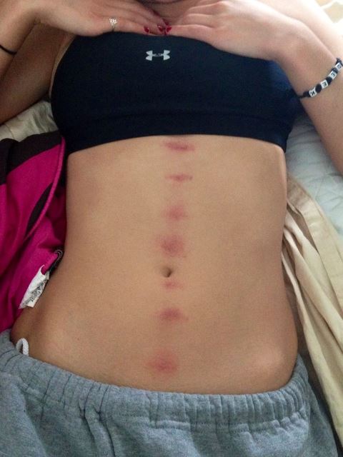 hickey