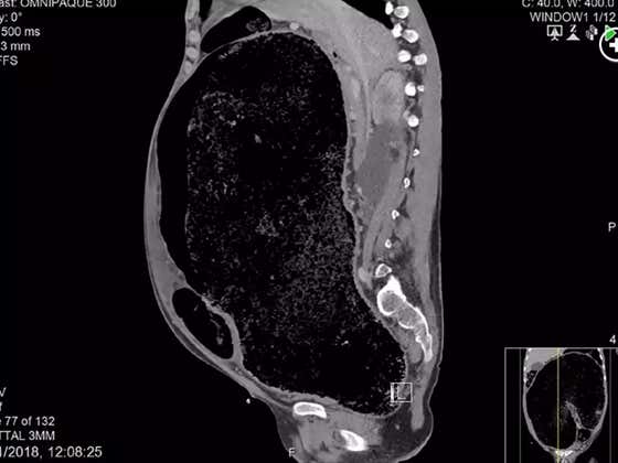 London Man Battles Megarectum And Nearly Dies From Not Pooping: I Blame Pop Culture